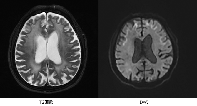 図2：NIIDの頭部MRI所見